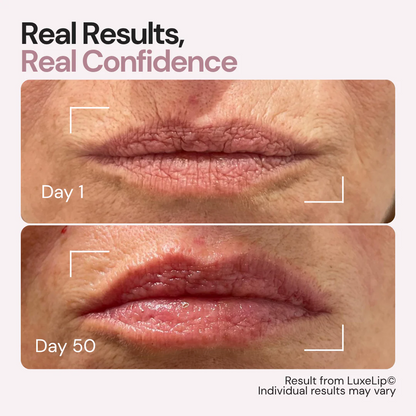 The First 4-Wavelength LED Lip Device - The Real Alternative to Lip Fillers That Rejuvenates Your Lips From Within