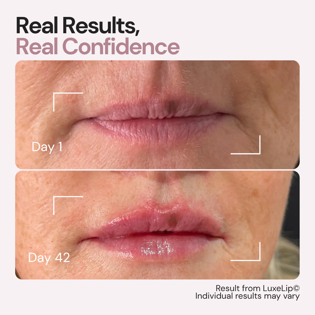 The First 4-Wavelength LED Lip Device - The Real Alternative to Lip Fillers That Rejuvenates Your Lips From Within