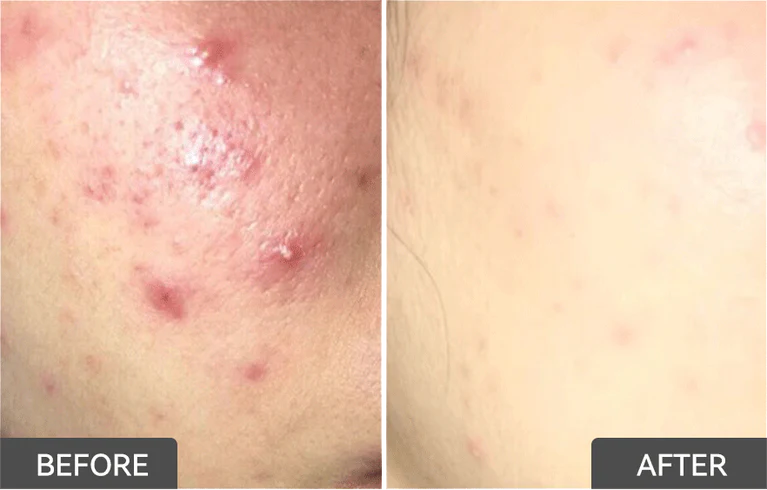 Salicylic Acid Acne Treatment