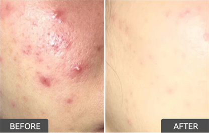 Salicylic Acid Acne Treatment